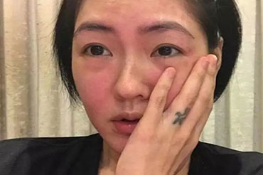 換季皮膚過(guò)敏怎么辦？六大致敏誤區(qū)!